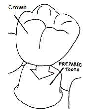 Drawing of a prepared tooth with a crown.