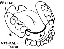 image of partial denture